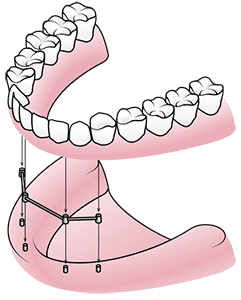 bar_retained-1